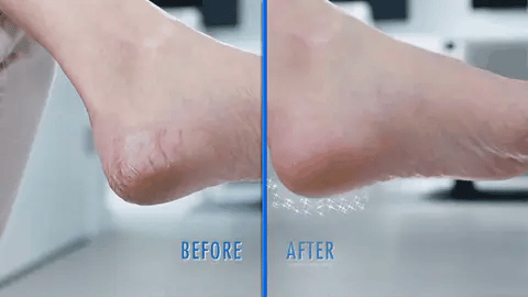 Say Goodbye to Rough Heels: The Benefits of an Electric Callus Remover Foot Grinder
